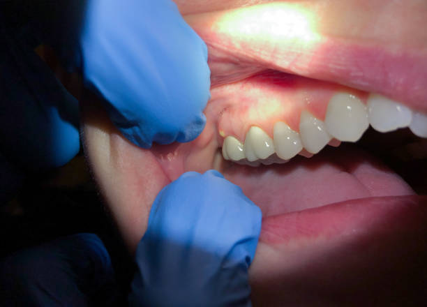 Best Chipped Tooth Repair Near Me  in Lido Beach, NY